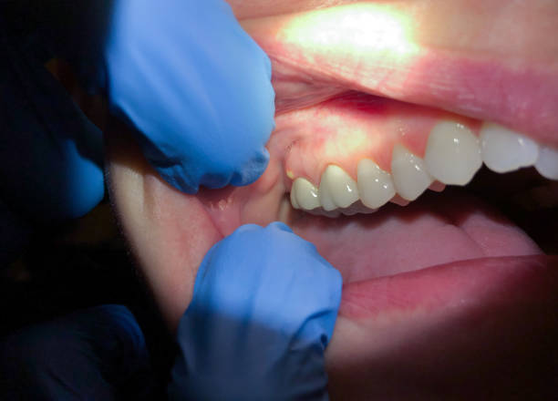 Best Emergency Dental Services for Seniors in Millington, NJ